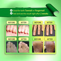 Golden Nutrition Nail Fungus Treatment, Nail Repair Solution, Restoring Healthy Nails,Rapid Nail Fungus Elimination Restoring Solution With Lasting Effects
